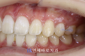치료 후 ③