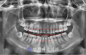 치료 후 ①