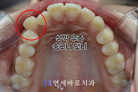 치료 전 ④