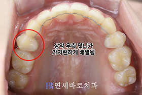 치료 후 ④