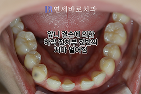 치료 전 ⑤