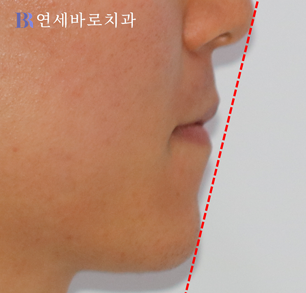 초진 측면 안모