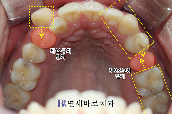치료 중 자료