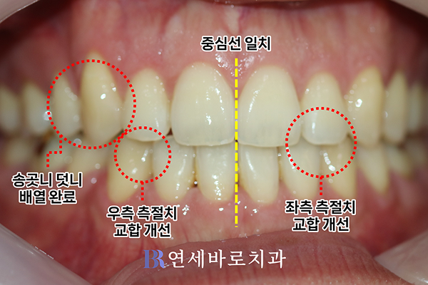 치료 후 정면 구내 사진