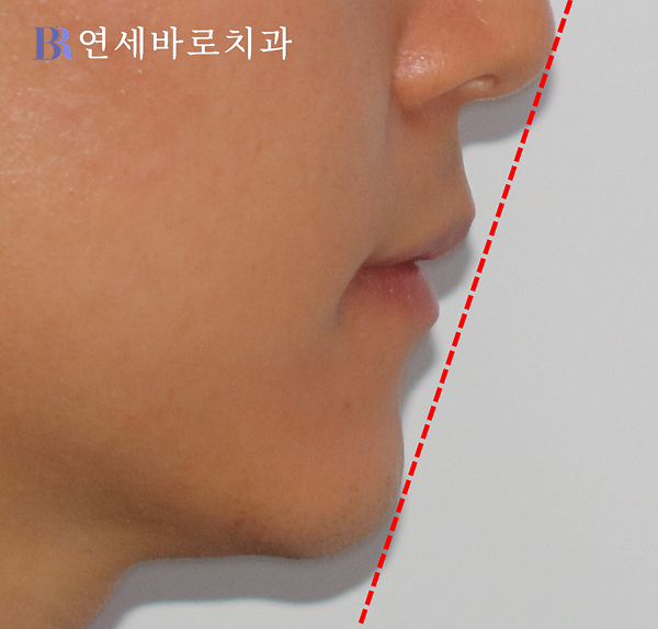 치료 후 측면 안모