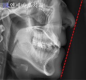 치료 전 ①
