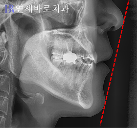 치료 후 ①