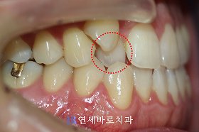 치료 전 ②