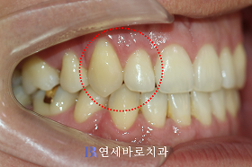 치료 후 ②
