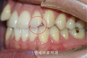 치료 전 ③
