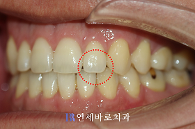 치료 후 ③