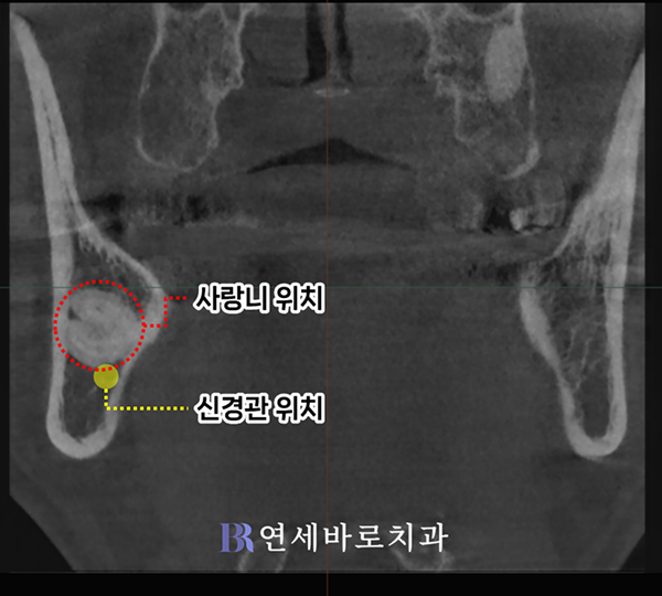 수평 매복 사랑니 확대