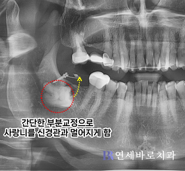미니스크류로 사랑니 세우기