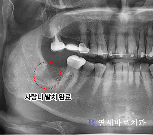 발치 후 엑스레이