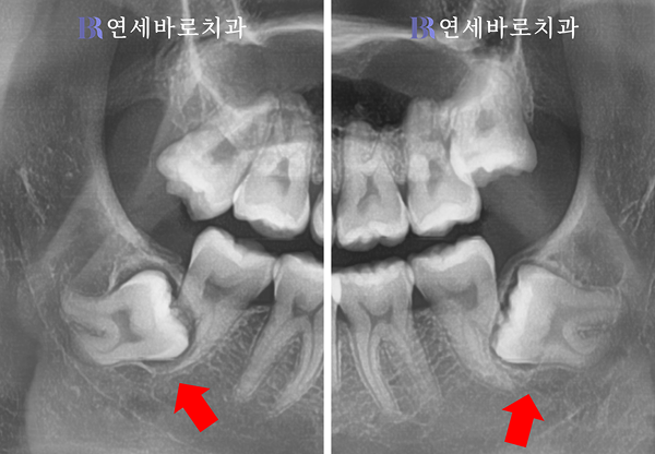 제2대구치 치근 흡수 확대