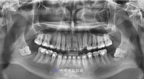 제2대구치 발치 후 교정 시작