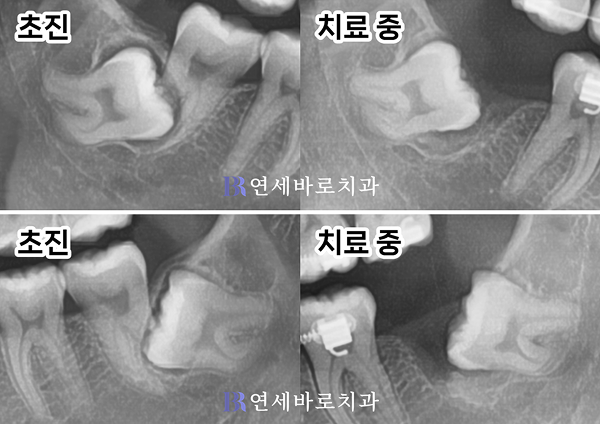 교정 중간 경과