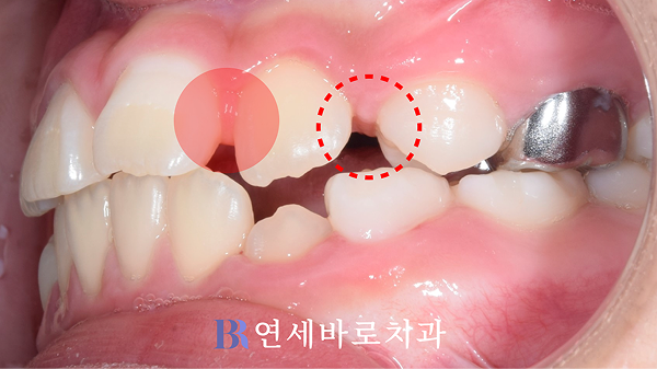 상악 좌측 견치 부위