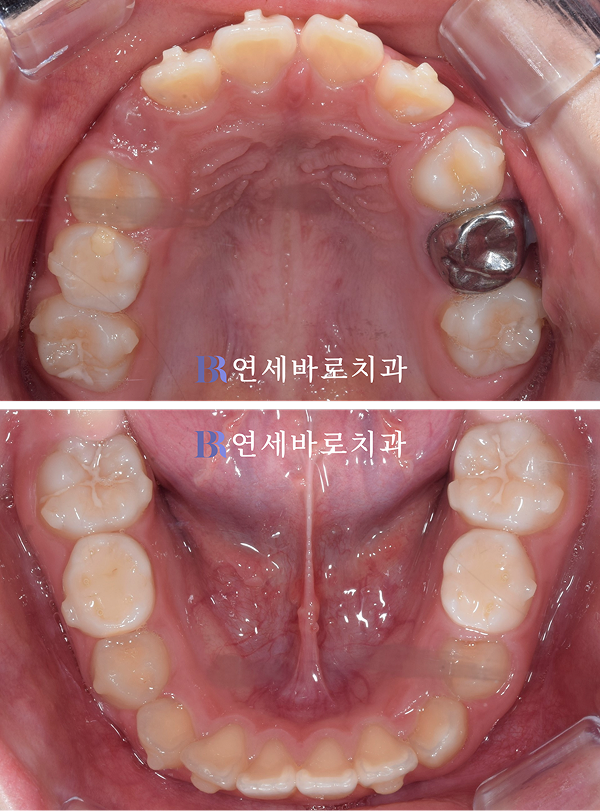 어태치먼트 부착