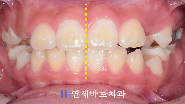 치료 후 정면 구내 사진