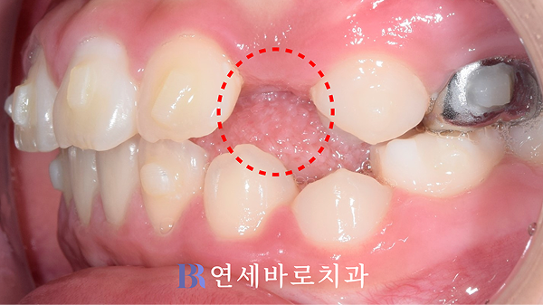 견치 맹출 공간 확보