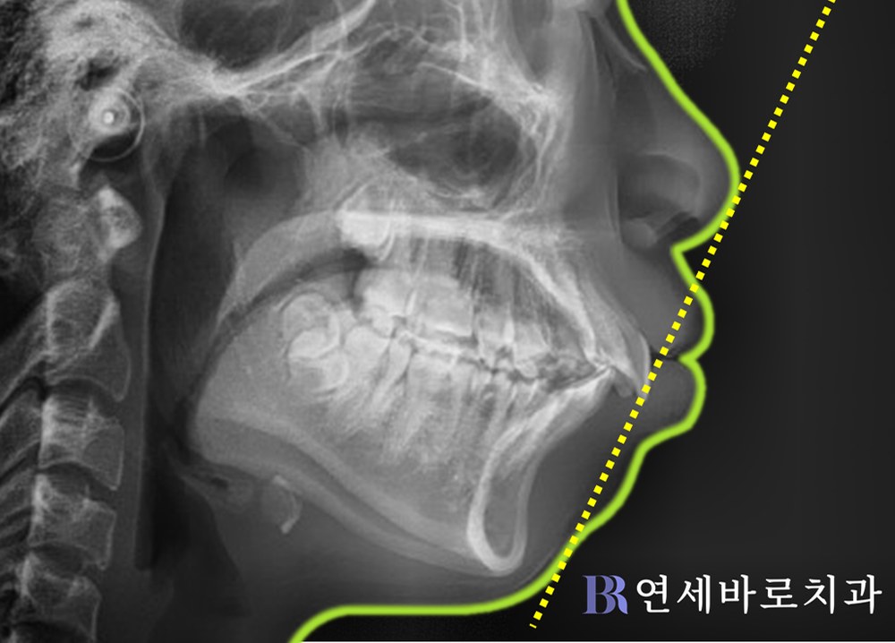 대전 무턱 교정 치료 전 측모 엑스레이