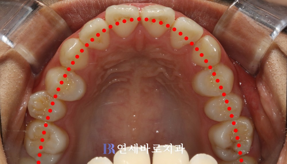 치료 전 상악 치열