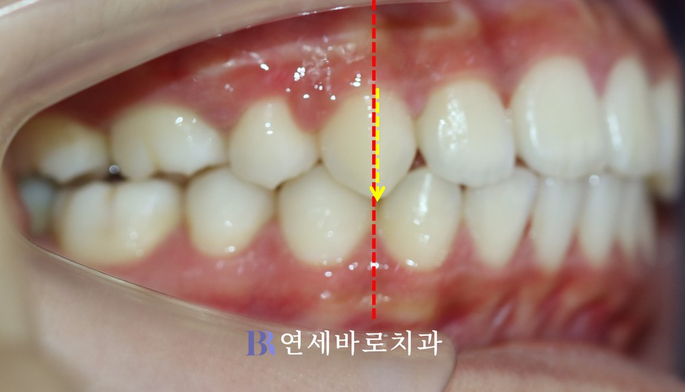 치료 후 우측 교합