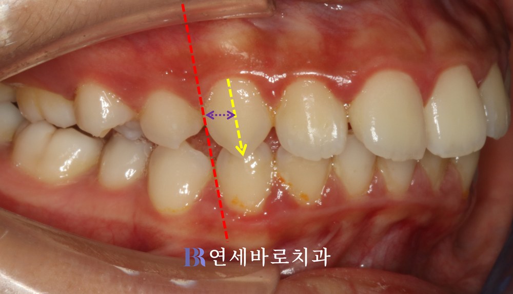 치료 전 우측 교합, 윗니와 아랫니의 전후 관계