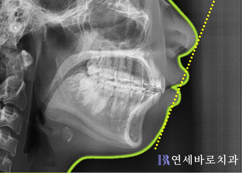 대전 무턱 교정 치료 후 측모 엑스레이