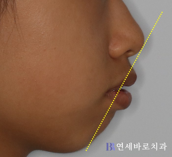 치료 전 ①