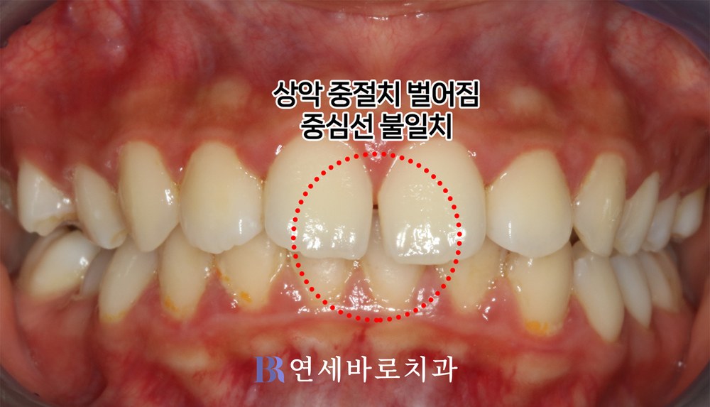 치료 전 정면 교합, 상악 중절치 벌어짐과 중심선 불일치