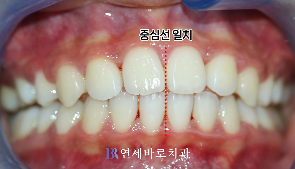 치료 후 정면 교합, 중심선 일치