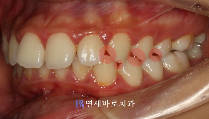 치료 전 ②
