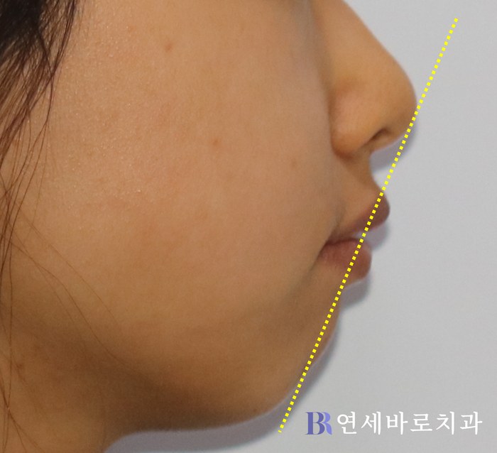 치료 후 ①