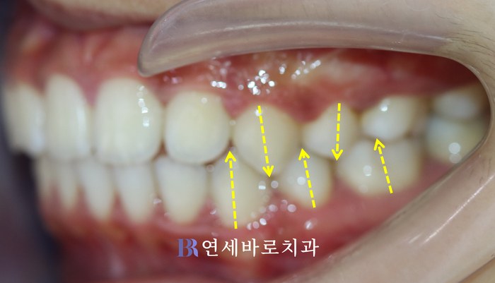 치료 후 ②