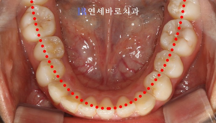 치료 전 ③