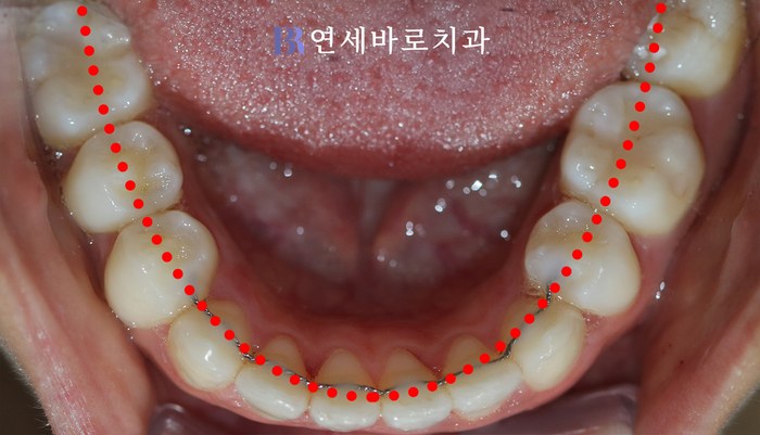 치료 후 ③
