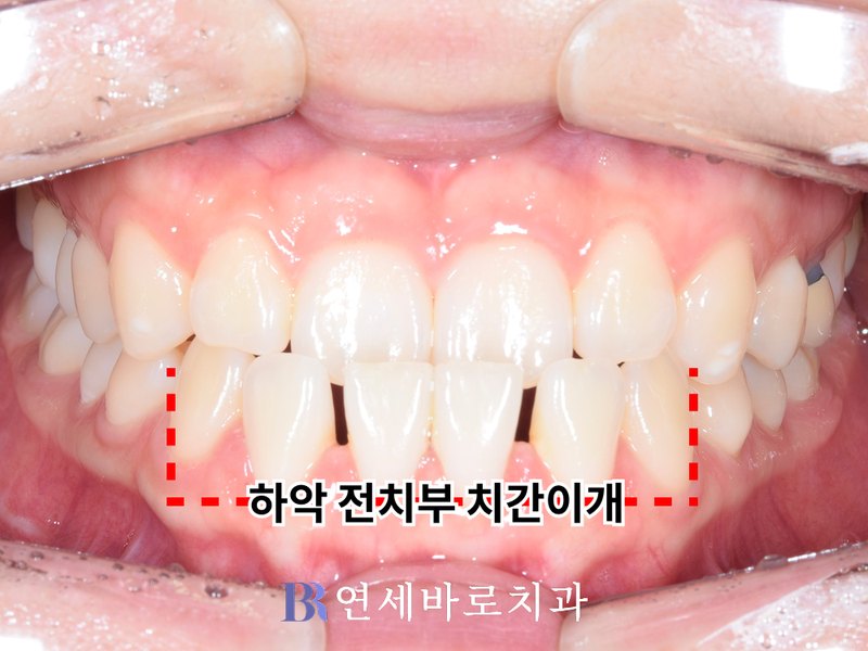 대전 노은동 치과 반대교합 치료 전 정면 구내 사진