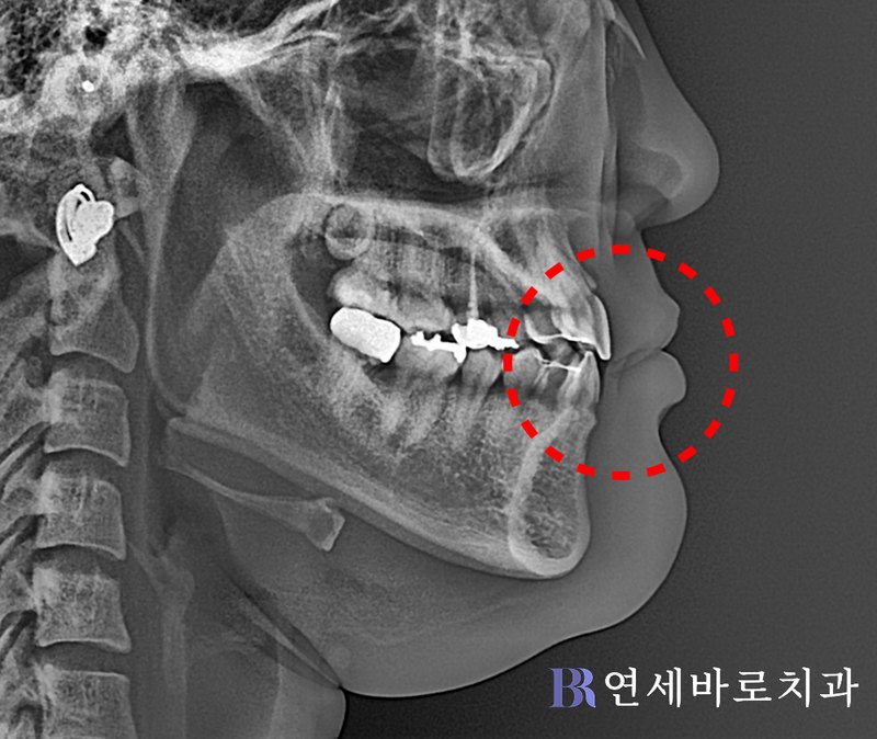 반대교합 치료 후 측모 두부방사선 사진