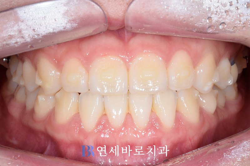 인비절라인 어태치먼트 부착 정면 구내 사진