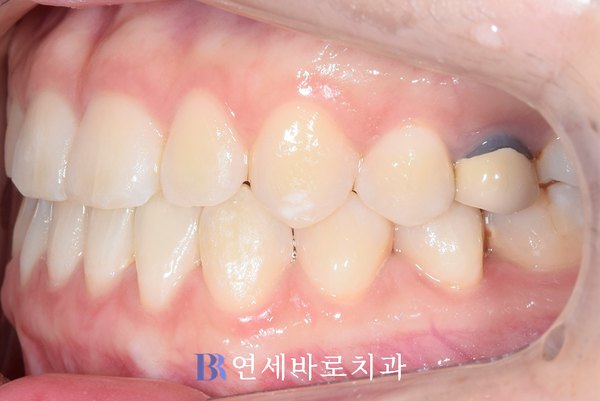 치료 후 ②
