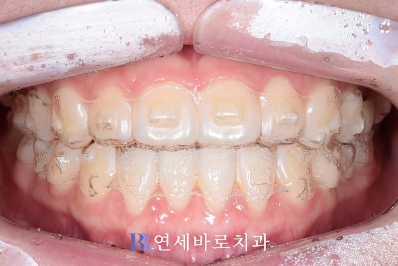 인비절라인 장착 정면 구내 사진