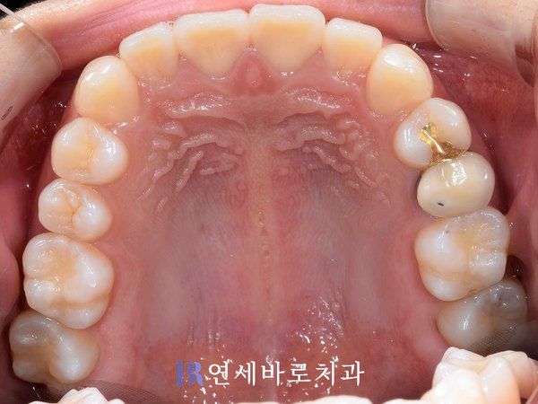 치료 전 ③