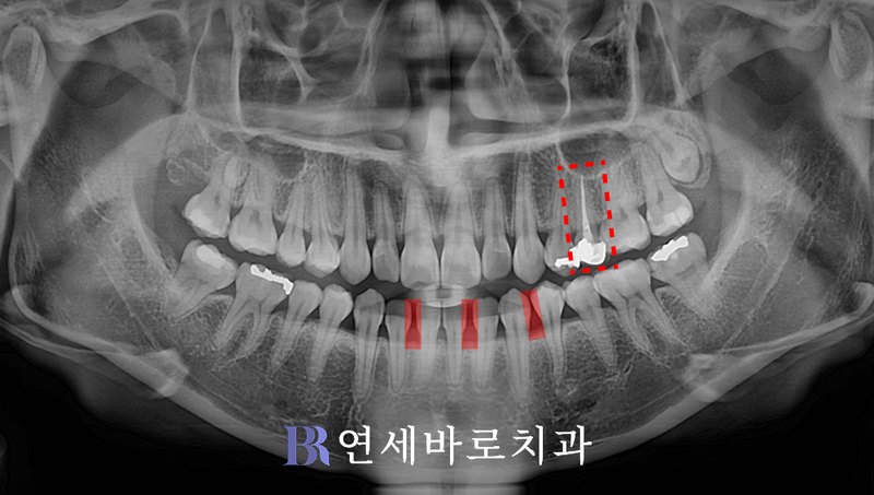 반대교합 치료 전 파노라마 사진