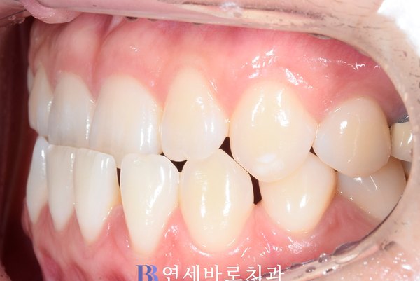 치료 전 ②