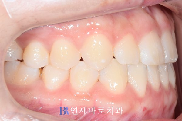 치료 후 ①