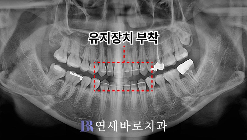 반대교합 치료 후 파노라마 사진, 설측 고정식 유지장치