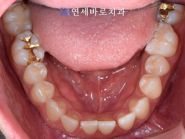 치료 전 ④