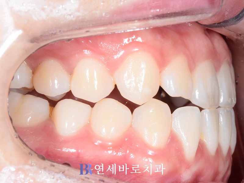 반대교합 치료 전 측방 구내 사진